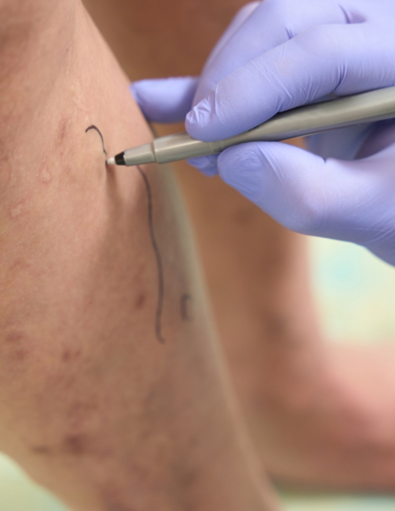 Dra Maria Betânia | Cirurgiã Vascular e Angiologista Especialista em Varizes em Brasília - DF. Tratamento modernos no conforto do consultório, sem internação.