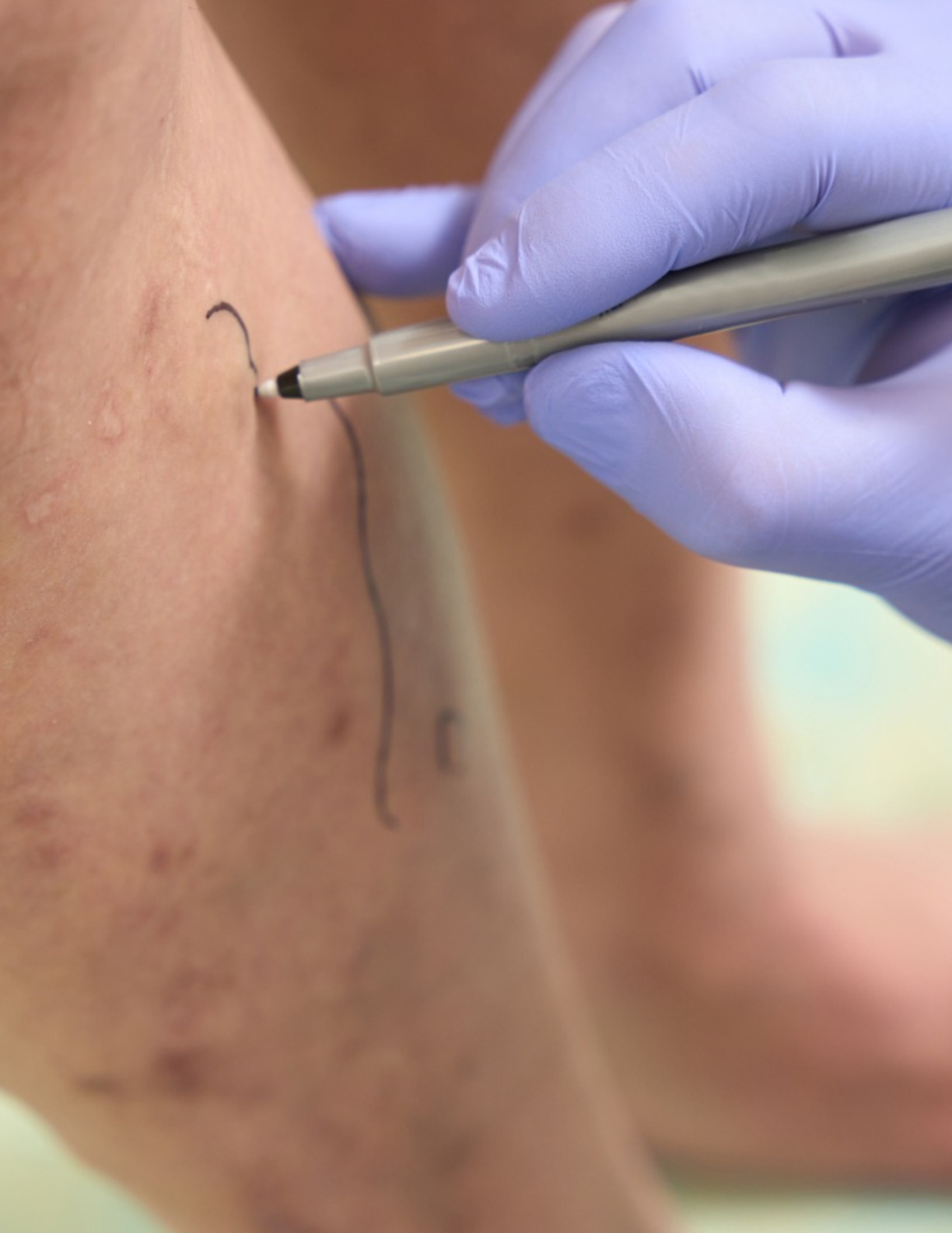 Dra Maria Betânia | Cirurgiã Vascular e Angiologista Especialista em Varizes em Brasília - DF. Tratamento modernos no conforto do consultório, sem internação.